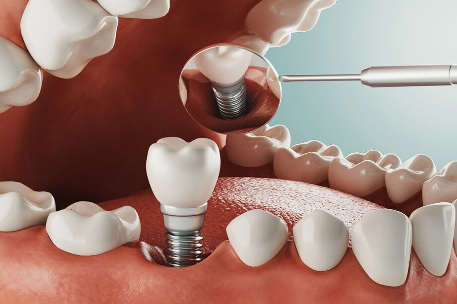Same-Day Dental Implants: A Smile Game-Changer